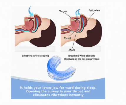Snorzz Anti-Snoring Mouthpiece